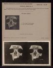 Frontal Sinus - no. 6